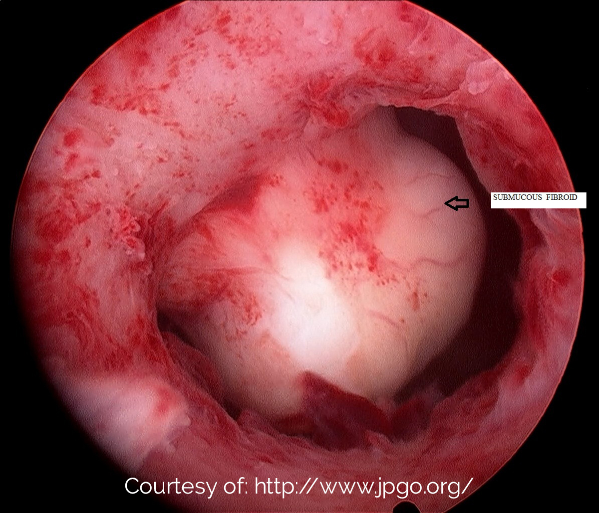 Submucosal fibroid seen at a hysteroscope