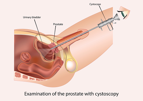 Dr.Stanley Friedell, MD, Image For Hysteroscopy